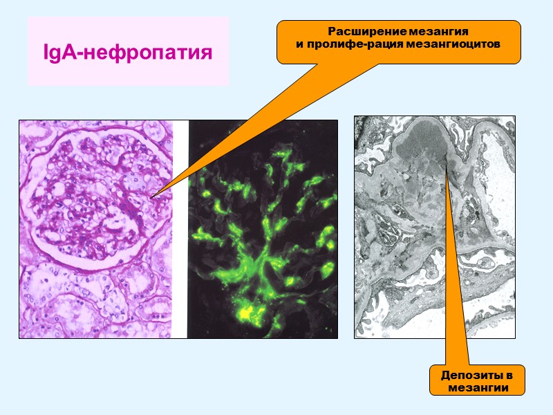 IgA-нефропатия Расширение мезангия  и пролифе-рация мезангиоцитов Депозиты в  мезангии